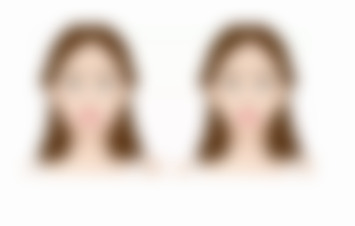 凹陷性疤痕修复有技巧！美学提示与护理要点