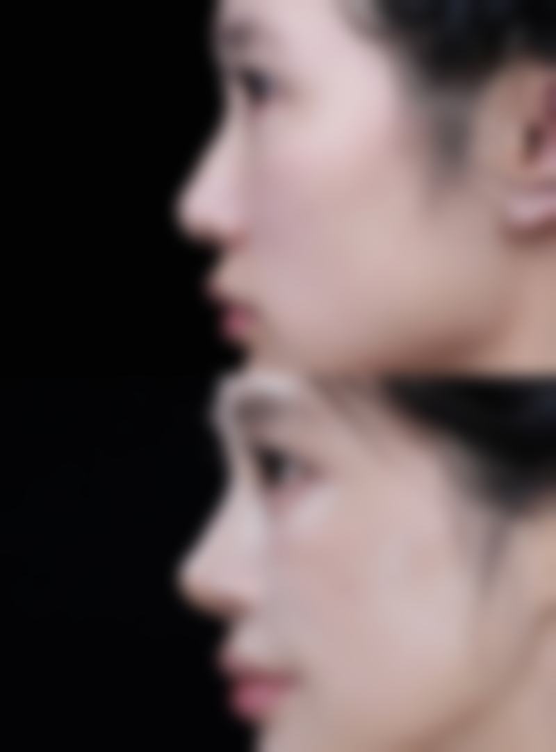 选对医院医生，为假体安心保驾护航