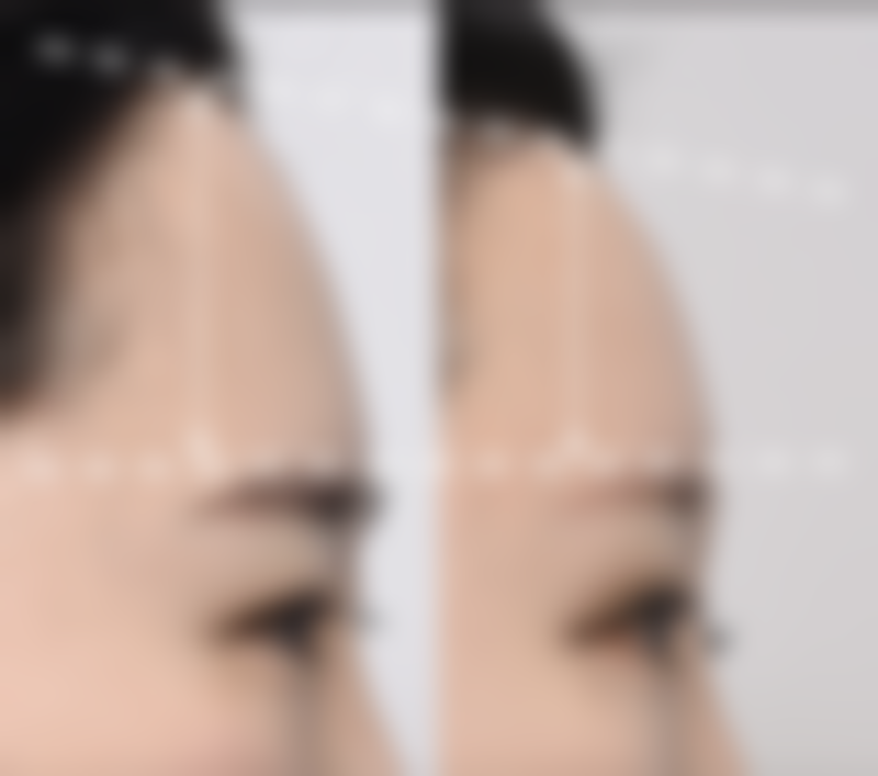 凹陷性疤痕能恢复！多种医美方案助力，专业医院为你重塑光滑肌肤 