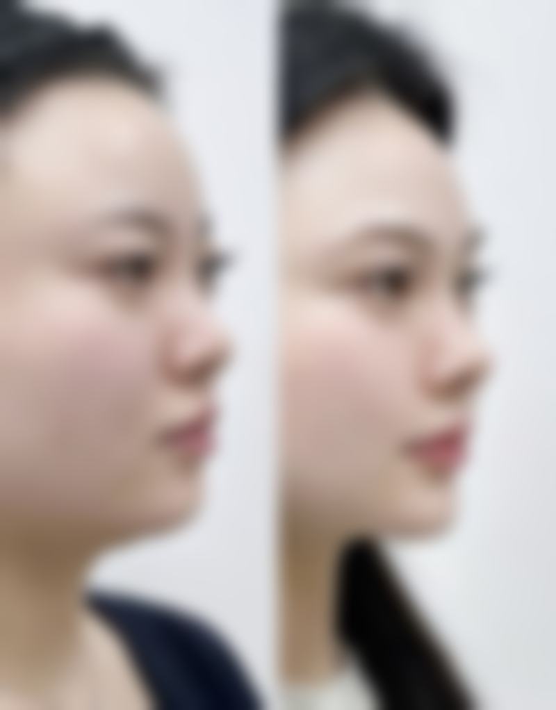 探秘热门合资隆胸假体有哪些！多款优质之选，兼顾性价比与卓越术后效果 