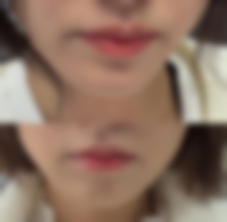 割双眼皮后护理小贴士：咖啡之外的注意事项