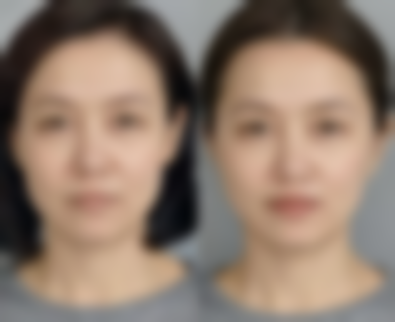 抽脂手术时长揭秘：术前评估的重要性