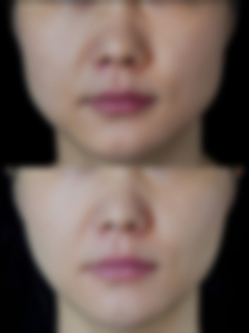 做隆胸多久能恢复自然？3 - 6个月达稳定状态，各阶段恢复要点揭秘 