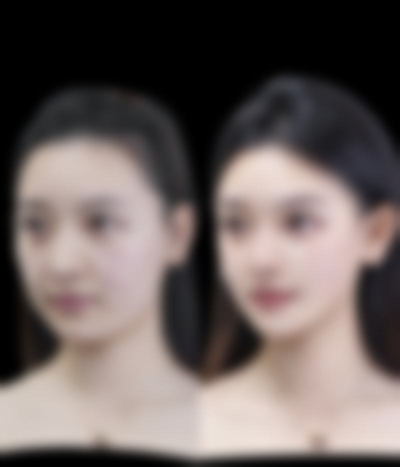 痘痘导致的增生疤痕：耐心等待，迎接平滑肌肤