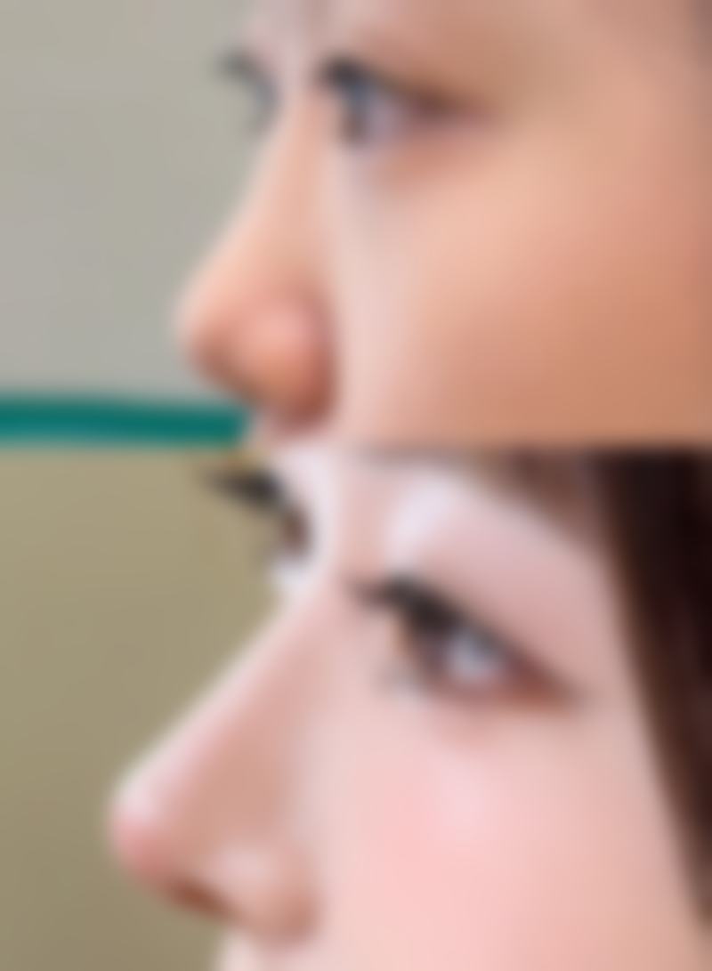 消除疤痕性痘痘有何妙招？早期预防不能少