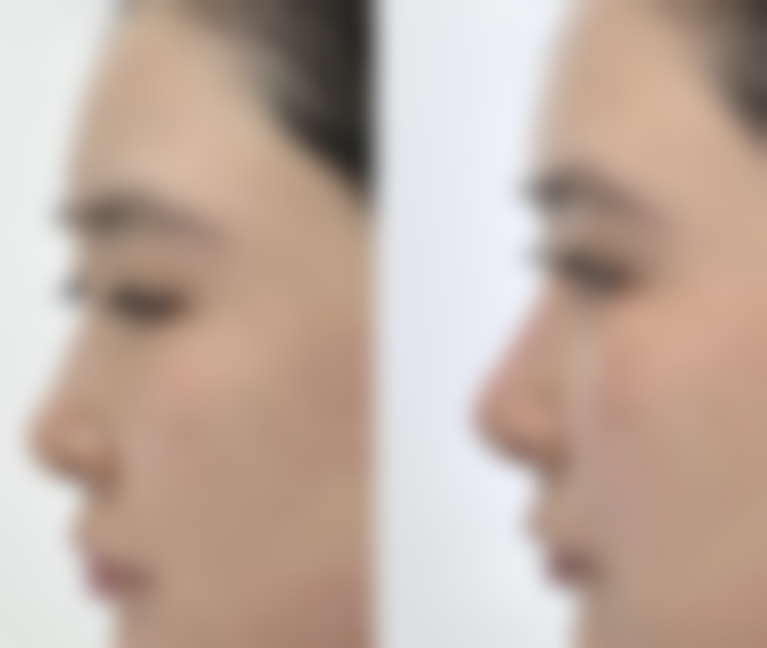 做隆胸后不同阶段，身体有啥变化？