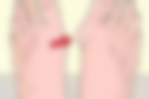 三点定位双眼皮手术，眼皮厚者的另一种选择优势