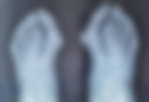 饮食调节：助力快速消肿的秘密武器