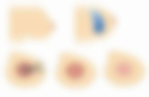 眼袋手术后怎样快速消肿？术后护理、饮食调节与生活习惯多管齐下促恢复 