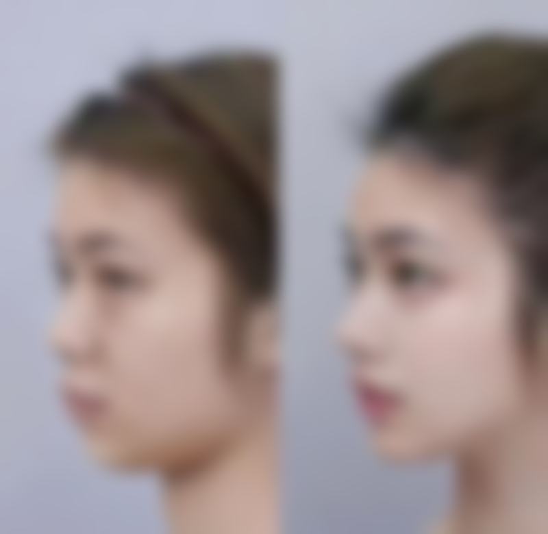 想知道去除眼袋的医美方案？这些主流方法别错过