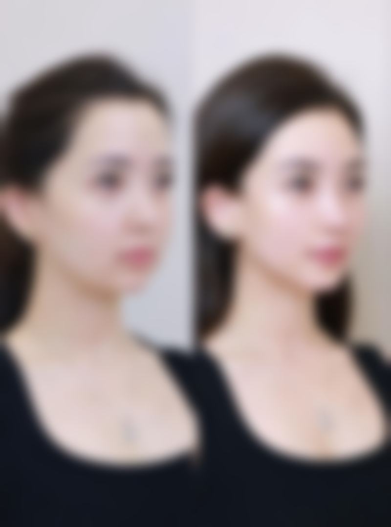 眼袋手术安全有保障吗？多种术式可选，专业操作与术后维护助你安全变美 