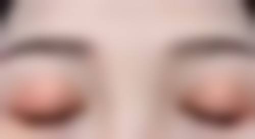 玻尿酸丰太阳穴：快速见效的“便捷派”