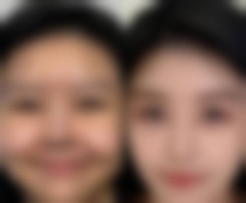 选对医院打瘦脸针，保护修复更放心