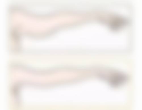 激光去除缝针疤痕的适用情况