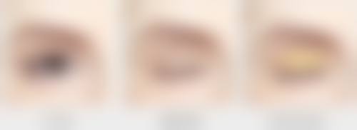 激光去除缝针疤痕的优势