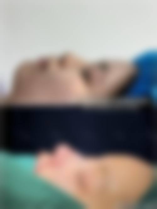 李增产双眼皮手术实例