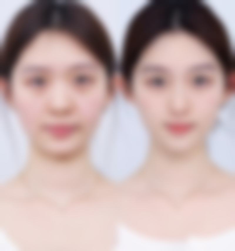 割双眼皮放大双眼的具体成效体现