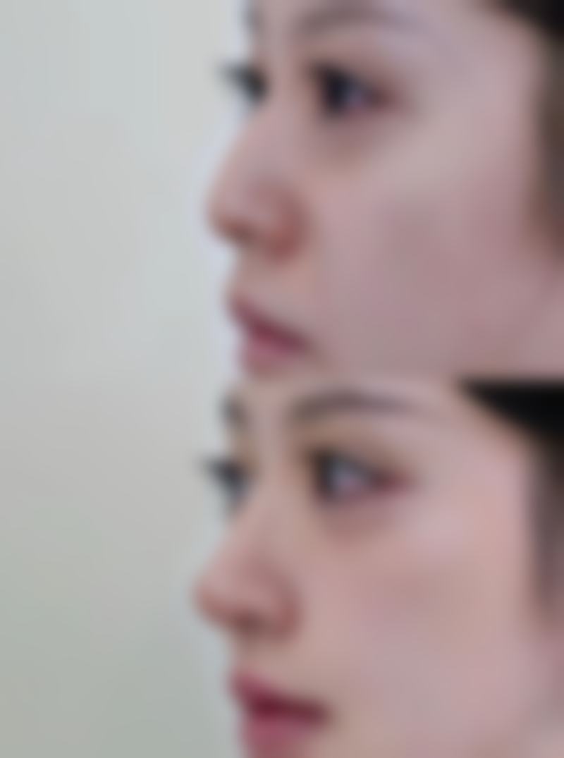 术后注意事项：悉心呵护让成效更持久