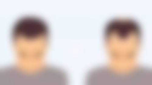 皮肤紧致时，先做双眼皮的优势