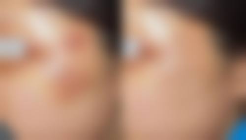 切痣留下的疤痕多久能消除？3 - 12个月软化淡化，揭秘医院改善疤痕全攻略 