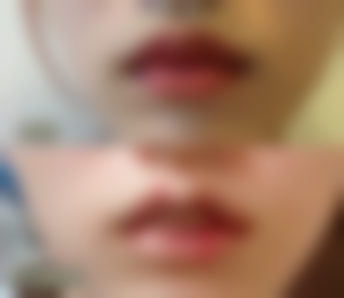 四、邢台市桥西王桂华专精美容实例