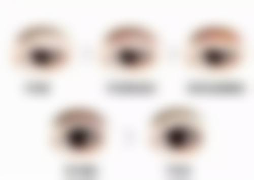 丰太阳穴材料之自体脂肪：持久自然的美丽秘诀