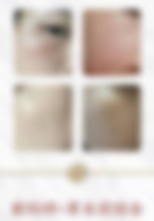 郑凤兰激光祛斑实例