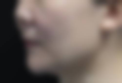 何晓雅注射除皱实例