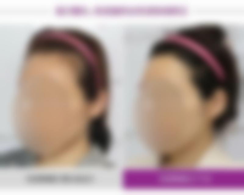 不同眼型对应专属方案，安心改善双眼皮形态