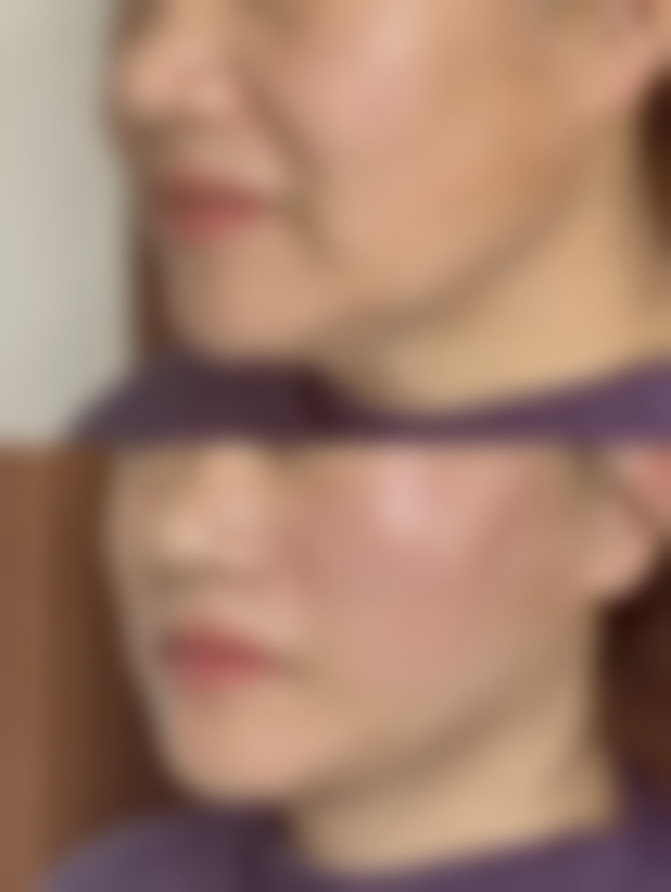 耿丽娟激光美容实例