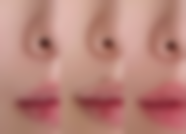 张步涛隆胸实例