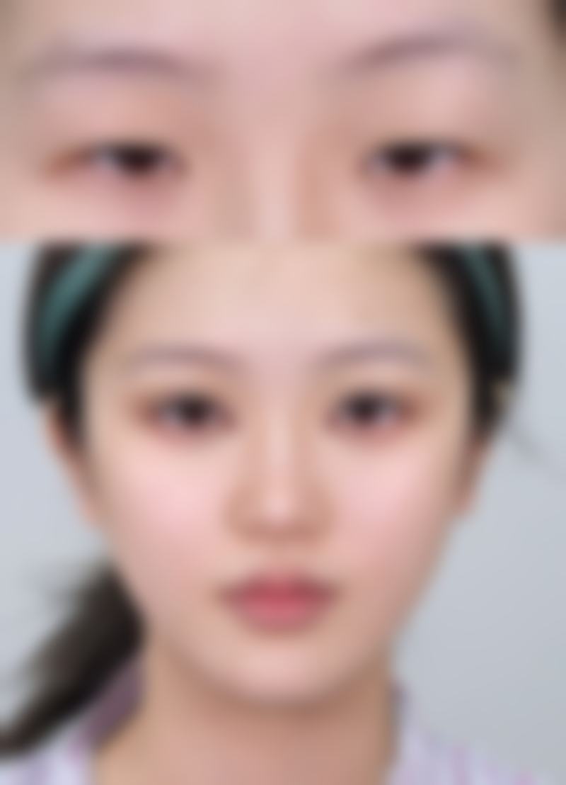 瘦脸针注射单位怎么选？依据咬肌状况精准定制，助你实现自然瘦脸效果 