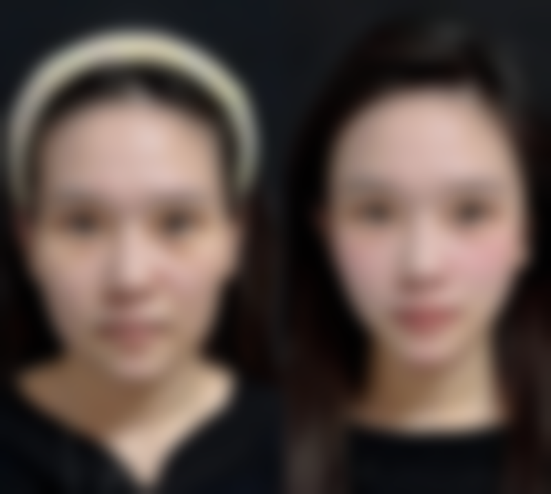 张步涛隆胸水平怎么样可靠吗？