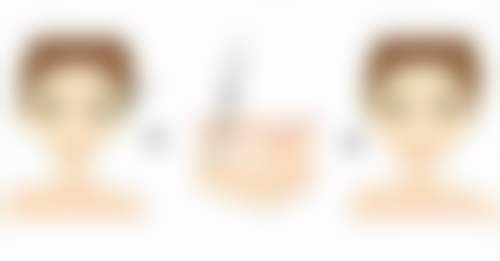 美学提示要记牢，正规治疗凹陷疤痕兼顾形态质感