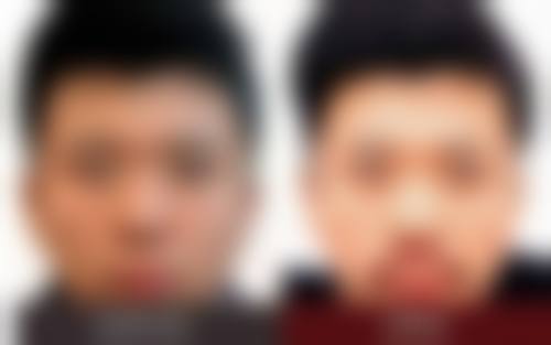 邓本文头发种植实例