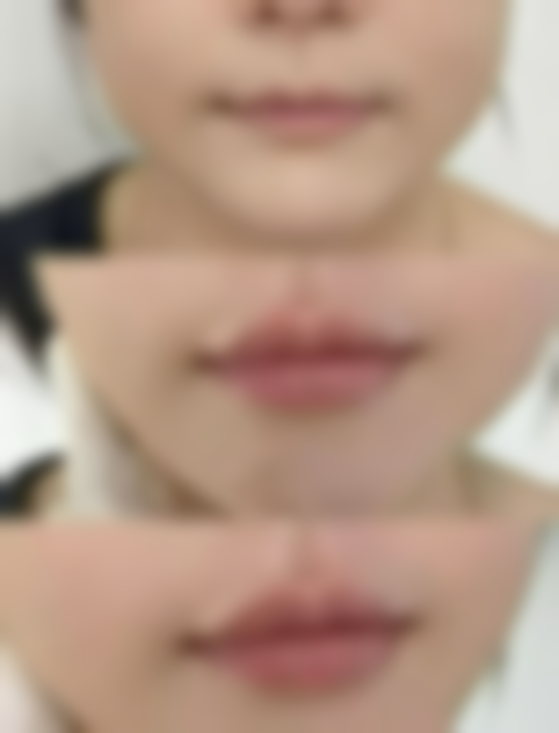 如何快速告别眼袋和黑眼圈？眼袋的非手术改善方法