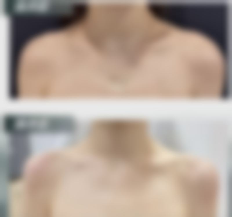 开水烫伤疤痕增生怎么治疗？多种方案可选，专业医院助力疤痕修复与肌肤新生 