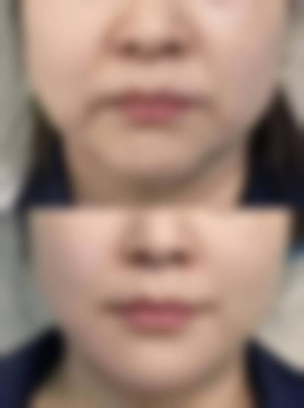 疤痕体质去除黑色素沉淀：轻医美干预有绝招