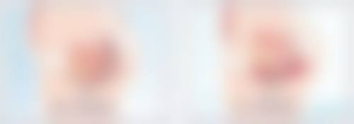 打瘦脸针后修复期运动强度怎么加？循序渐进是关键