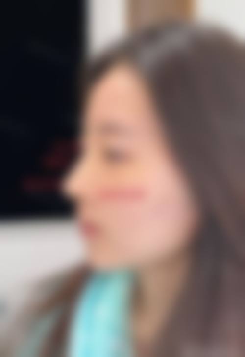 杨志超重睑术实例