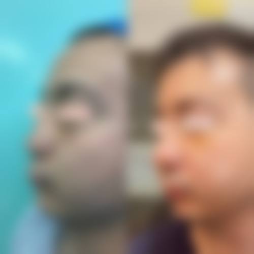 周冉鼻部综合美塑术实例