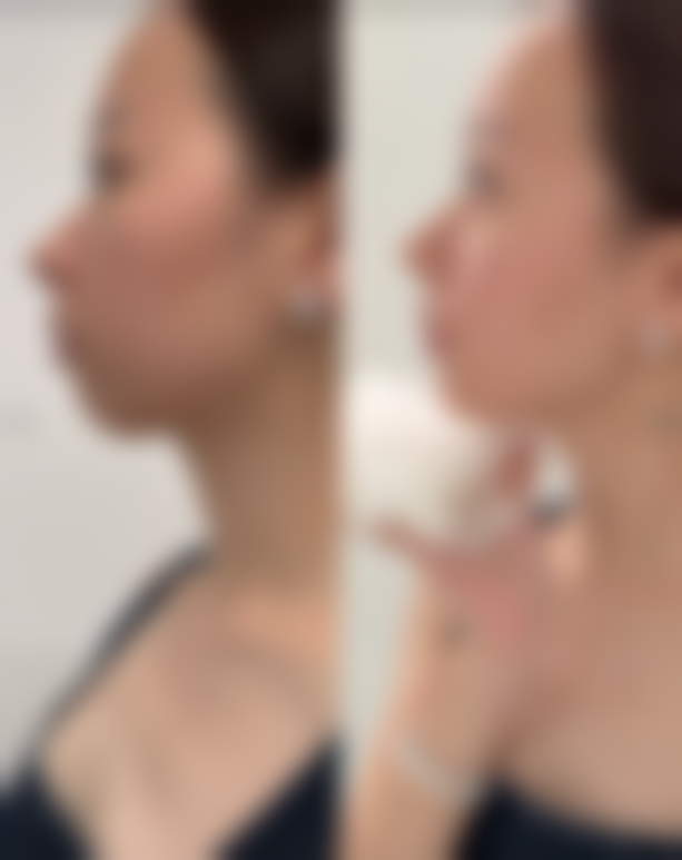 曹志明激光祛斑实例