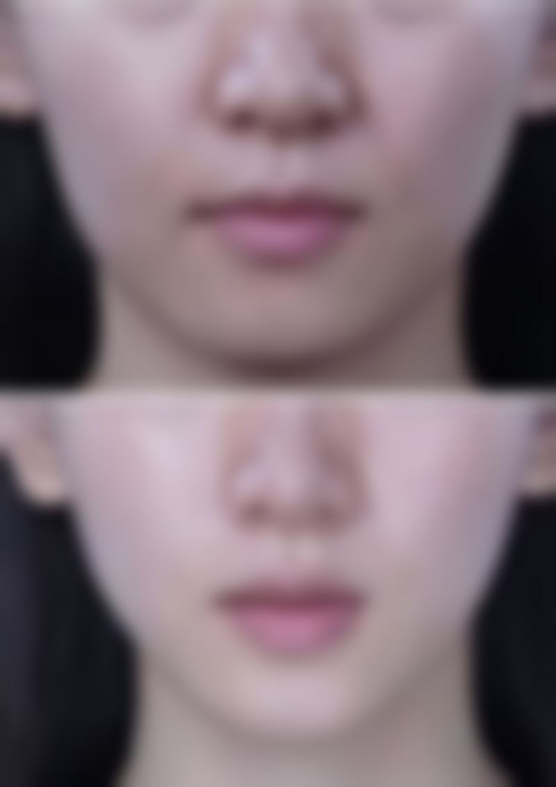 哪种双眼皮手术更适合你？术后护理小贴士