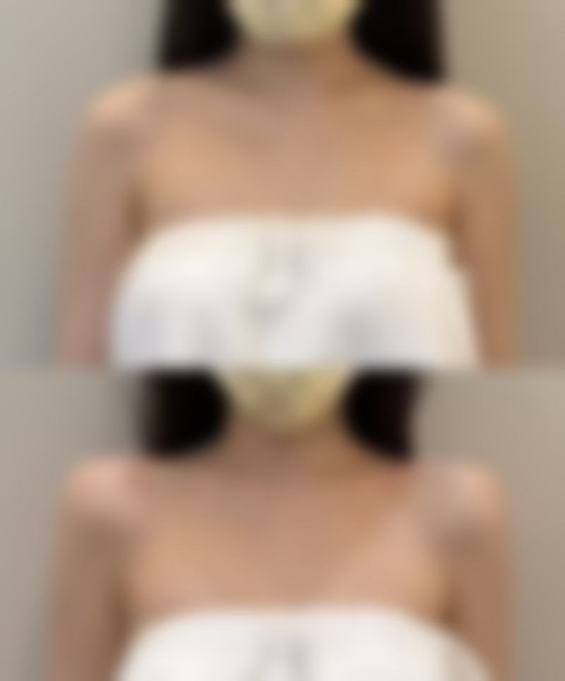 医院多举措加速锁骨骨折手术疤痕淡化