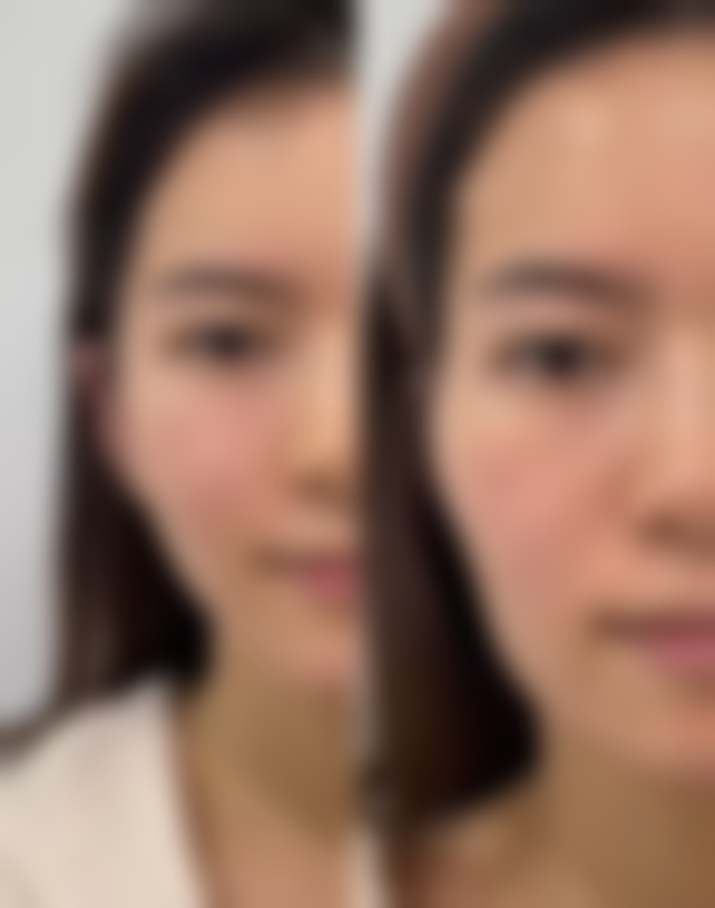 哪种双眼皮手术更适合你？医院选择指南