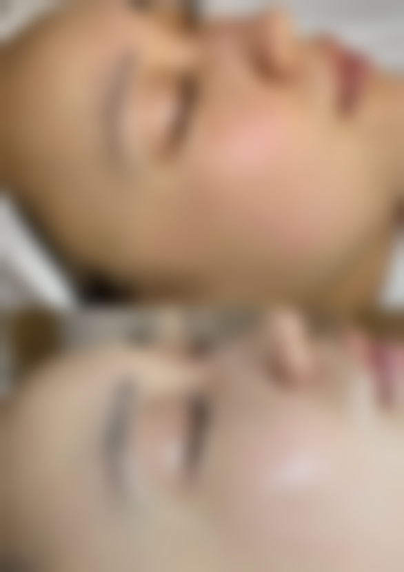 膨体耳软骨隆鼻修复大揭秘：多样修复方式，满足不同需求