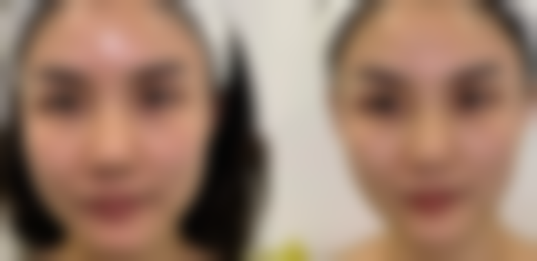 双眼皮手术拆线后多久能碰水？24 - 48小时逐步碰水，术后护理有妙招！ 