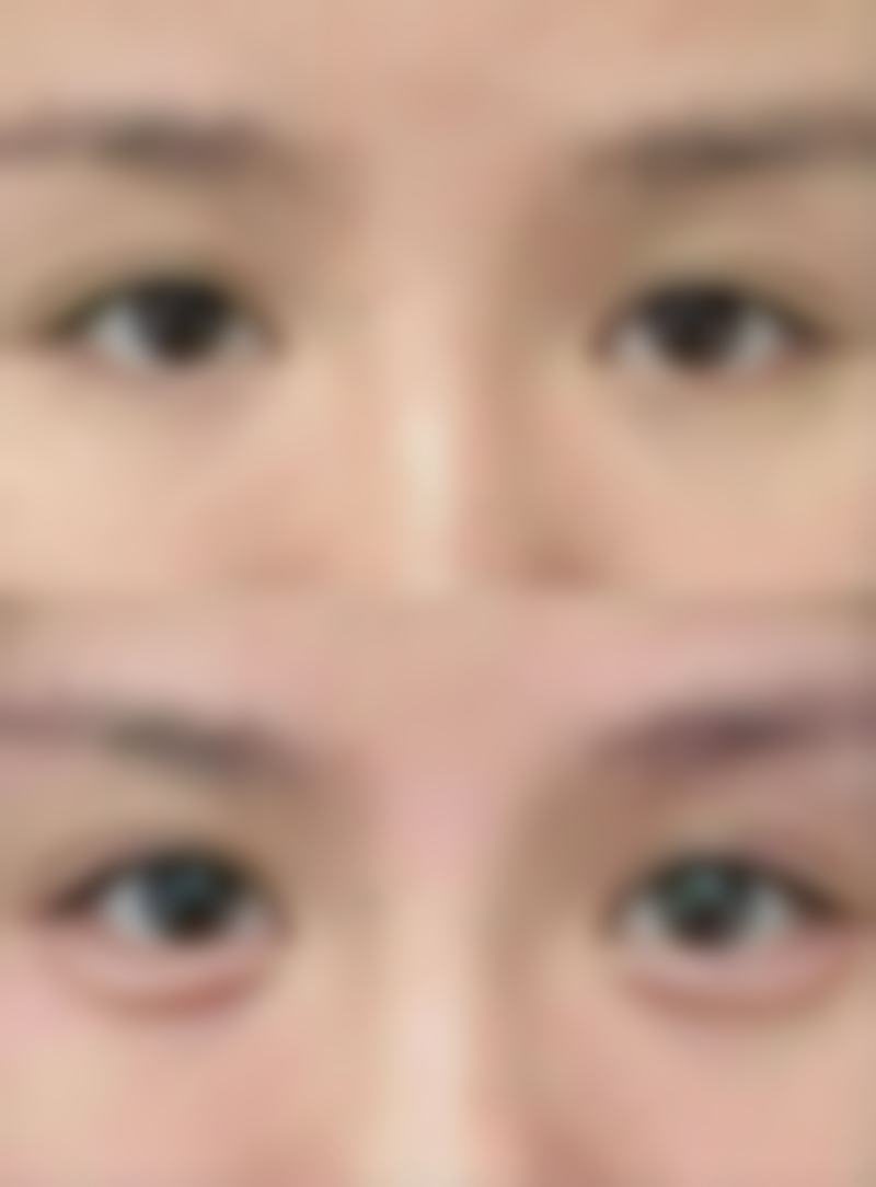 医院优势助力锁骨骨折手术疤痕修复