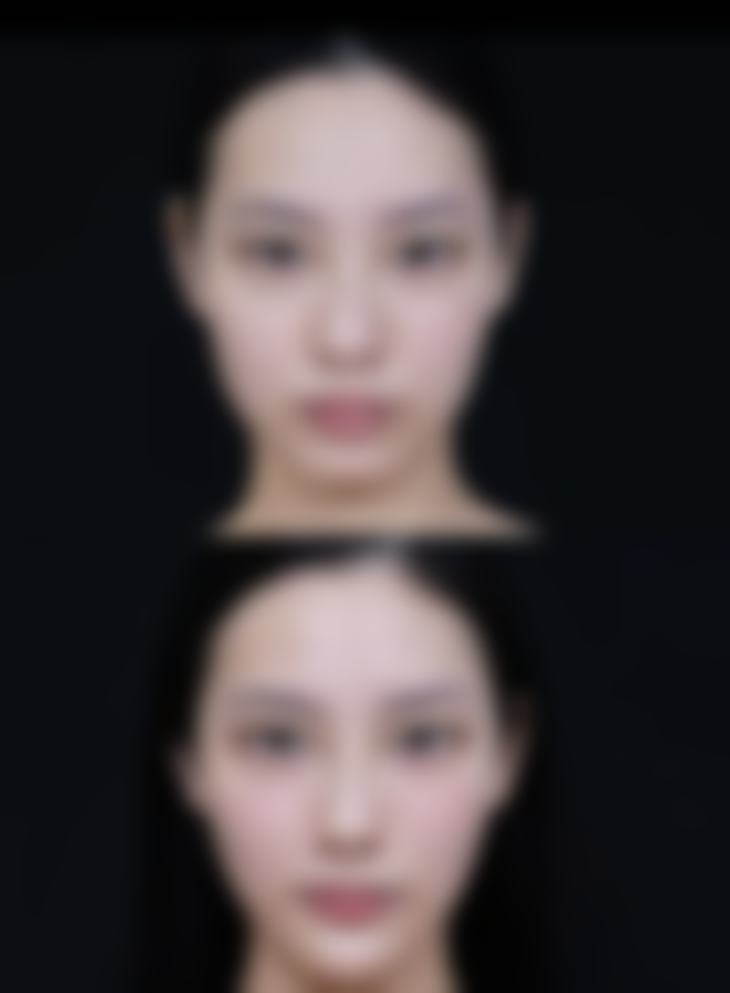 瘦脸针半月效果未显莫慌！了解起效因素与应对法，助你打造精致轮廓 