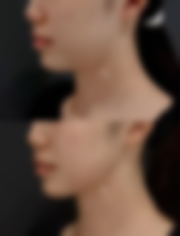 优质膨体材料隆鼻咋选？综合考量做出至佳选择